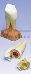 Upper Twin-Root Molar with Caries , 2 part